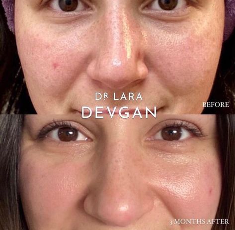 Dr. Lara Devgan Scientific Beauty on Instagram: "Real client results with my RETINOL+BAKUCHIOL SERUM Here we can see beautiful improvement in pore size, hyperpigmentation, and overall skin tone. My Retinol+Bakuchiol Serum is my #1 anti-aging essential for preventing, correcting, and achieving a clear and radiant complexion. RETINOL is a hero anti-aging ingredient that improves smoothness of the skin. BAKUCHIOL is a plant-based anti-oxidant and anti-inflammatory that is structurally similar Bakuchiol Serum, Anti Aging Regimen, Retinoic Acid, Medical Questions, Daily Sunscreen, Antioxidant Serum, Hyaluronic Serum, Polysorbate 80, Anti Aging Ingredients