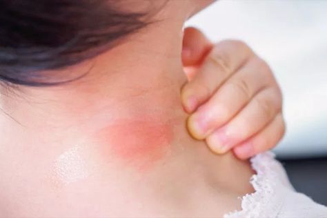 17 Signs Your Bug Bite Is Something Serious | Best Life Infected Bug Bite, Red Bug Bites, Love Bite Boyfriend, Types Of Bug Bites, Diy Mice Repellent, Chronic Hives, Spider Bite, Love Bite, Types Of Spiders