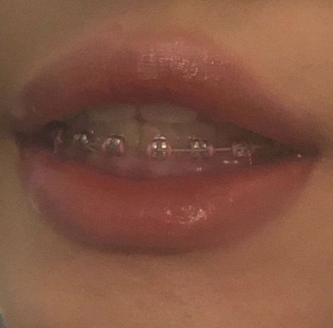 Bottom Braces Only, Bottom Teeth Braces, Bottom Braces, Pink Braces, Teeth Aesthetic, Cute Braces Colors, Cute Braces, Dental Implants Cost, Brace Face