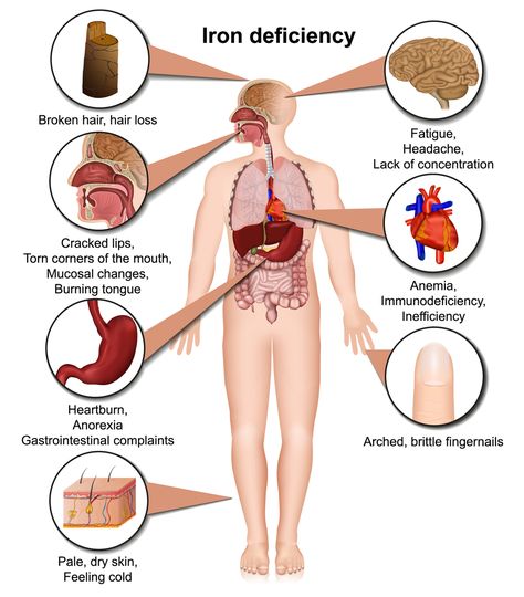 Could Iron Deficiency Anemia Be Draining You? 8 Critical Tests to Know 2 Low Ferritin, Signs Of Iron Deficiency, Scientific Method Worksheet, Thyroid Recipes, Iron Supplement, Calcium Supplements, Iron Deficiency, Thyroid Function, Stomach Acid