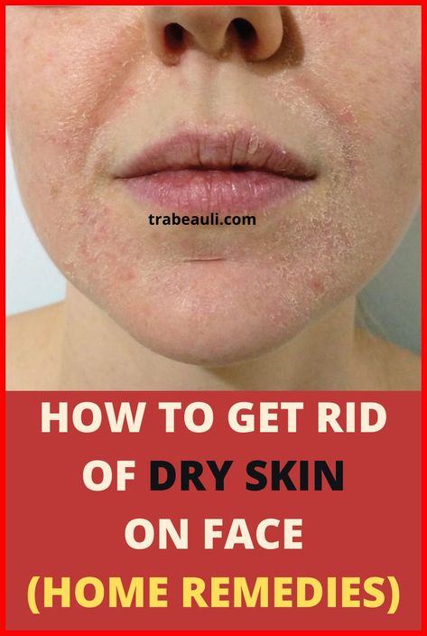 Natural Hacks For Your Skin Problems Extremely Dry Face, Dry Face Remedy, Flaky Skin On Face, Dry Skin Face Mask, Dry Peeling Skin, Get Rid Of Dry Skin, Good Moisturizer, Super Dry Skin, Facial For Dry Skin