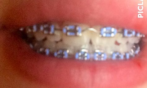 Light blue braces. Light Blue Braces Teeth, Braces Sky Blue, Braces Light Blue, Blue Braces Aesthetic, Light Green Braces, Navy Blue Braces Teeth, Fake Braces For Sale, Periwinkle Braces, Baby Blue Braces