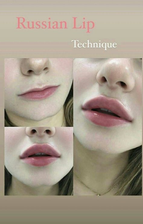 Face Plastic Surgery, Russian Lips, Lip Surgery, Lips Inspiration, Botox Lips, Pretty Nose, Perfect Nose, Facial Fillers, Facial Contouring