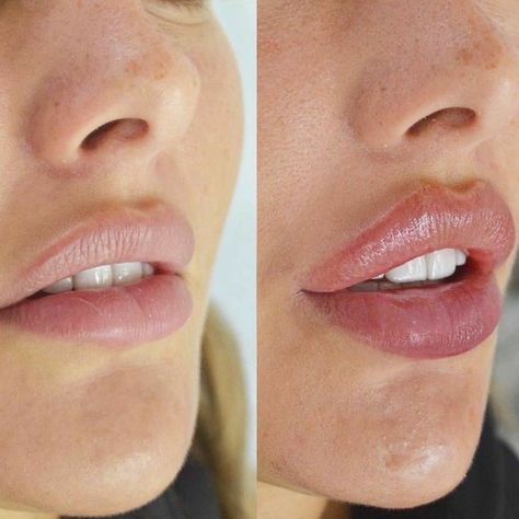 Lip Fillers Juvederm, Lip Background, Lip Blushing, Lips Sketch, Lips Painting, Lips Inspiration, Botox Lips, Cheek Fillers, Lip Wallpaper