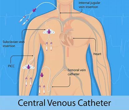 Central Line Catheter, Central Lines Nursing, Picc Line Nursing, Central Line Nursing, Iv Certification, Central Venous Catheter, Nursing Cheat, Interventional Radiology, Central Line