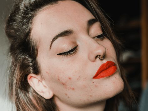 Cheek Acne: Causes and Treatments, According to Derms Remedies For Hormonal Acne, Blackheads On Cheeks, Cheek Acne, Tretinoin Cream, Skincare Remedies, Gentle Facial Cleanser, Moisturizer For Sensitive Skin, Hormonal Imbalance, Acne Facial