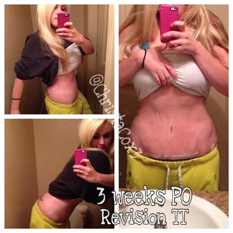 23 weeks post op update! #TummyTuck #Revision #Utah #Abdominoplasty Panniculectomy Before And After, Over Emotional, Tummy Tucks Recovery, Winter Beauty Tips, Mommy Makeover, Post Op, Tummy Tucks, Cosmetic Surgery, Plastic Surgery