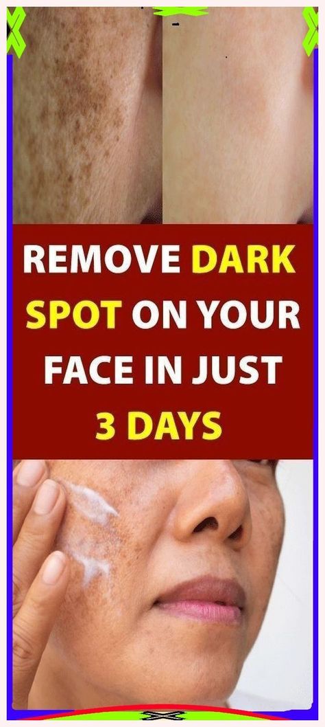 Thanks a bunch. Terrific information! Natural Botox, Dark Spots On Face, Eliminate Wrinkles, Brown Spots On Face, Spots On Face, Eye Anti Aging, Remove Dark Spots, Anti Wrinkle Cream, Best Anti Aging