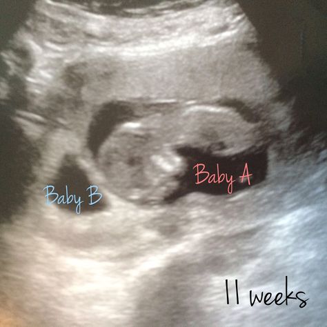 11-week ultrasound photo Twin Ultrasound Pictures 8 Weeks, 11 Weeks Pregnant Ultrasound, Ultrasound Pictures 8 Weeks, 11 Week Ultrasound, Twin Ultrasound, Vanishing Twin Syndrome, Vanishing Twin, Twins Ultrasound, Pumping Hacks