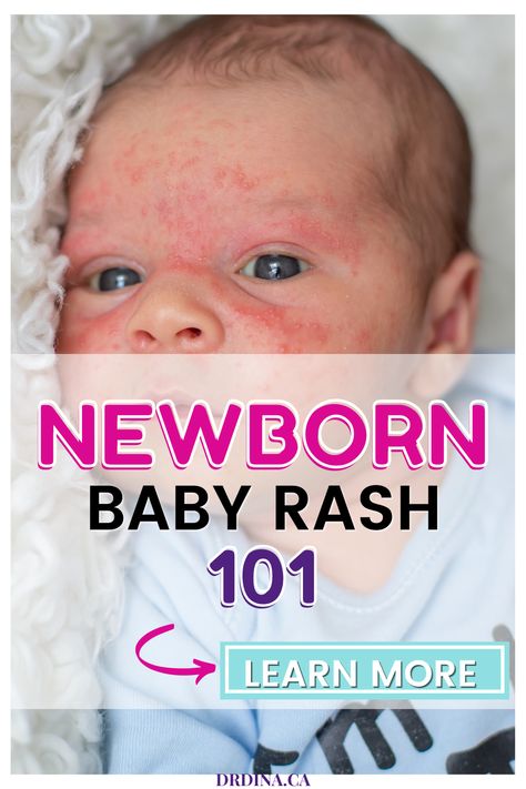 Parents often seek advice about rashes or skin changes their babies are born with or develop in the first few weeks or months of life. Rashes commonly cause stress for parents, as we want our kids to have flawless skin! Here we will review the most common rashes we see in the newborn and young-baby stages. Newborn Dry Skin, Newborn Rash, Skin Rash On Face, Viral Rash, Baby Rashes, Baby Skin Rash, Rash On Face, Baby Acne, Baby Stage