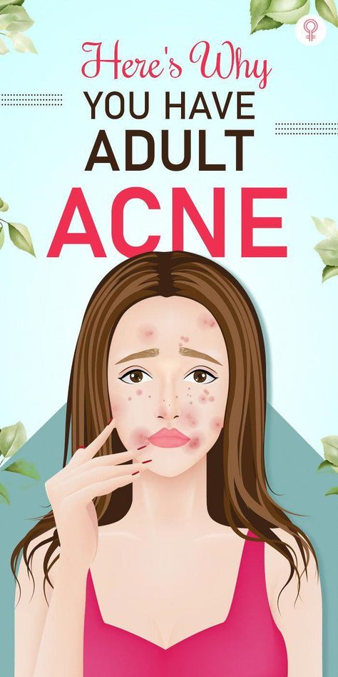 o you have adult acne. Yikes. Your parents say the teenage years are hard because, Comedonal Acne, Back Acne Remedies, Cystic Acne Remedies, Acne Hacks, Teenage Acne, Blind Pimple, Forehead Acne, Pimples Under The Skin, Hacks Makeup