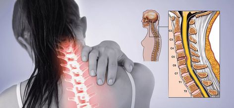 C5 C6 Neck Pain, Slip Disc, Whiplash Injury, Cervical Disc, Intervertebral Disc, Human Spine, Bulging Disc, Disk Herniation, Spinal Nerve