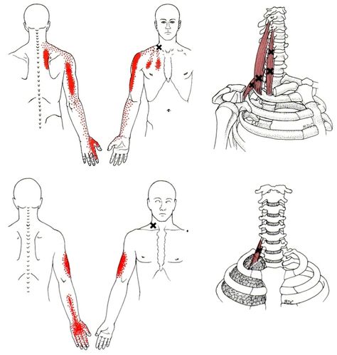 Myofascial Pain Syndrome – Back In Action Punkty Spustowe, Myofascial Pain Syndrome, Psoas Release, Referred Pain, Trigger Point Therapy, Tight Hip Flexors, Psoas Muscle, Trigger Point, Myofascial Release