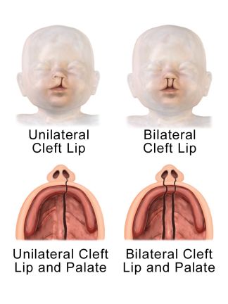 Unilateral_and_Bilateral_Cleft_Lip_and_Palate Cleft Lip And Palate Awareness, Obstetrics Nursing, Maxillofacial Surgery, Cleft Lip And Palate, Cleft Palate, Comparative Analysis, Cleft Lip, Lip Drawing, Aesthetic Medicine