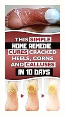 You’ve really inspired me. Unbelievable info! Cracked Heel Remedies, Cracked Heel, Cracked Heels, Peeling Skin, Homemade Remedies, Simple Home, Simple House, Mind Blown, Home Remedies