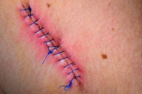 Medical Stitches, Stitches Medical, Types Of Stitches, Wound Care, Stage Makeup, After Surgery, Wound Healing, Skin Healing, Delicate Bracelet