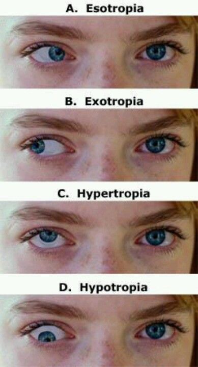 Crossed Eyes, Vision Therapy, Medical School Studying, Medical School Essentials, Medical Anatomy, Eyes Problems, Medical Knowledge, Medical Education, Anatomy And Physiology