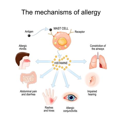 Histamine Intolerance, Itchy Eyes, Best Doctors, Abdominal Pain, Fermented Foods, Autoimmune Disease, Kombucha, Genetic, Migraine