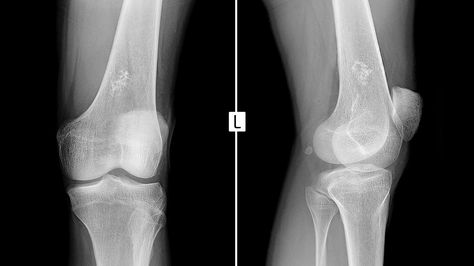 Ewing Sarcoma: Symptoms, Pictures, More Ewings Sarcoma, Arm Bones, Body Bones, Pet Scan, Mri Scan, Magnetic Resonance Imaging, Things Under A Microscope, The Bone, Clinical Trials