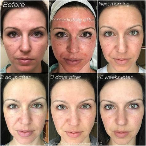 Vampire Facial | Platelet Rich Plasma Facial | Dr. Kass Plasma Facial, After Microneedling, Facial Before And After, Dermapen Microneedling, Forehead Acne, Vampire Facial, Laser Resurfacing, Skin Structure, Cosmetic Procedures