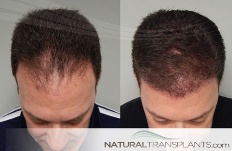 Hair Transplants Can Dramatically Change How You Look and Feel. Are you looking for a fuller, natural looking head of hair that will make you look and feel better? Are you wanting to increase your confidence and self-esteem? Hair Implants, Hair Transplant Cost, Hair Transplant Results, Hair Transplant Procedure, Dunner Wordend Haar, Hair Doctor, Fue Hair Transplant, Hair Transplant Surgery, Best Hair Transplant