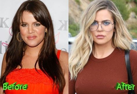 Khloe Kardashian Plastic Surgery, Kardashian Tattoo, Kardashian Plastic Surgery, Excessive Underarm Sweating, Botox Brow Lift, Plastic Surgery Procedures, Khloé Kardashian, Celebrity Plastic Surgery, Under The Knife