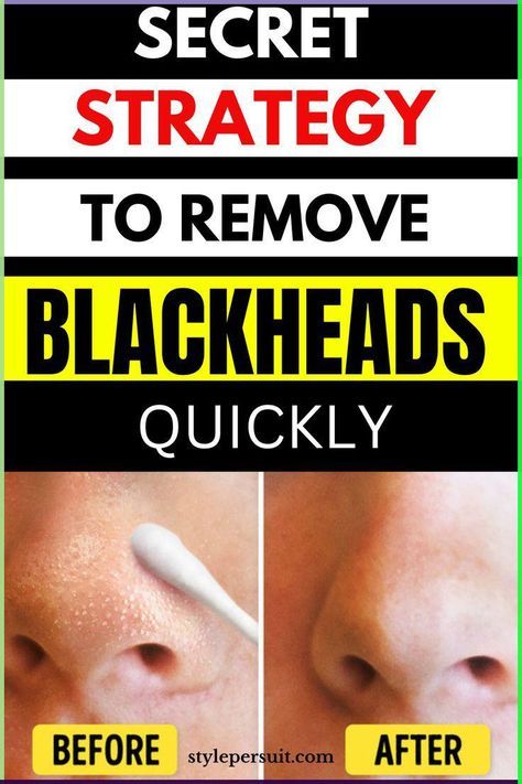 What To Use For Blackheads, How To Get Rid Of White Heads On Nose, How To Remove Blackheads From Nose, Blackhead Removal Diy, Black Head Remover Diy, How To Get Rid Of Blackheads, Clogged Pores On Nose, Blackheads Nose, Blackheads Removal Cream