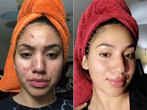 Teen who suffered severe acne shares miracle routine which cleared her skin – using just four budget products, including Dr. Bronner's Castile Soap. Natural Acne, Severe Acne, Acne Remedies, Jason Statham, Girl Tips, Crochet Hair, Acne Skin, Skin Tips, New Skin