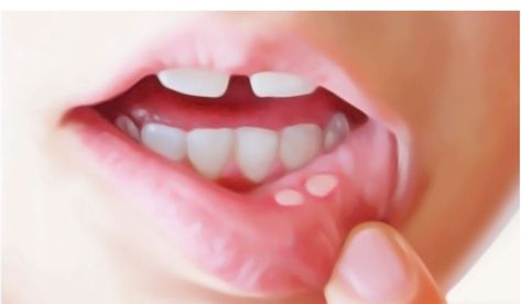 6 Easy Natural Remedies for Canker Sores - Web Health Journal Check more at https://buzgru.com/6-easy-natural-remedies-for-canker-sores-web-health-journal/ Mouth Blister Remedy, Blister In Mouth, Canker Sore Home Remedies, Mouth Blisters, Blister Remedies, Ulcer Remedies Mouth, Canker Sore Remedy, Mouth Problems, Best Teeth Whitening Kit