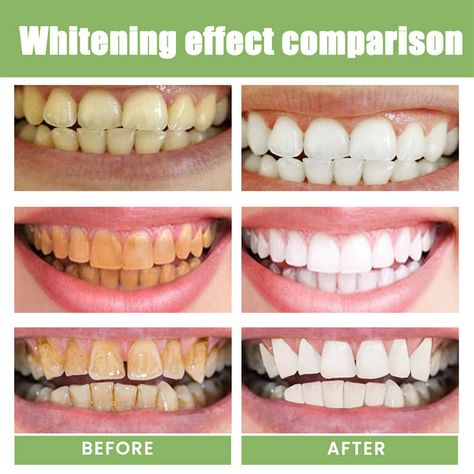 5 Day Teeth Whitening Powder Remove Plaque Stains Toothpaste Deep Cleaning Fresh Breath Oral Hygiene Dentally Tools Teeth Care https://s.click.aliexpress.com/e/_DCB6KLf #removeplaque #oralhygiene #teethwhitening #teethcare #stains Tooth Gel, Dental Plaque, Tooth Powder, Yellow Teeth, Stained Teeth, Dental Tools, Whitening Toothpaste, Teeth Care, White Teeth