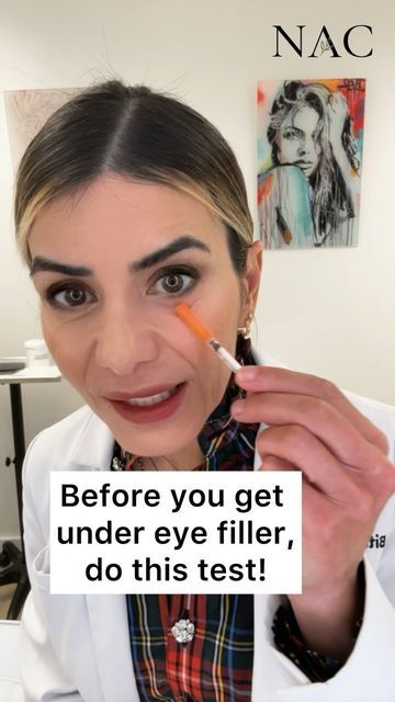 Botox Before And After Eyes, Eye Fillers Before And After, Filler Under Eyes Before And After, Under Eye Filler Before And After, Where To Get Botox On Face, Tear Through Eye Filler, Mid Face Filler, Botox Under Eyes, Facial Balancing Filler