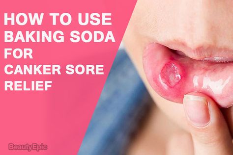 baking soda for canker sore Mouth Sore Remedy Kids, Mouth Sore Relief, Canker Sore Remedy Overnight, Canker Sore Relief, Ulcer Remedies Mouth, Canker Sore Remedy, Medical Remedies, Baking Soda Scrub, Baking Soda For Hair