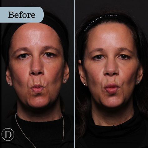 Natural looking lip filler before and after result at Dermetics Cosmetic Dermatology clinic in Burlington Ontario. #lipfiller #beforeandafterimage Natural Lip Fillers, Dermatology Clinic, Burlington Ontario, Cosmetic Dermatology, Lip Filler, Natural Lip, Lip Fillers, Natural Lips, Dermatology