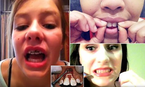 Worrying trend sees teenagers creating 'painful but cheap' DIY BRACES Diy Window Sill, Orthodontic Humor, Diy Braces, Braces Pain, Dental Humor, Double Take, Youtube Tutorials, Diy Phone Case, Cheap Diy