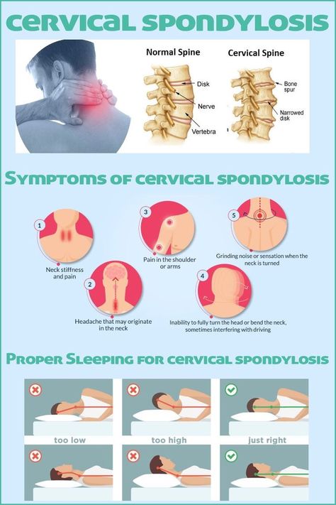 Cervical Spondylosis Exercises, Cervical Spine Exercises, Cervical Pain Exercises, Cervical Pain, Cervical Spondylosis, Cervical Spine, Neck And Shoulder Pain, Good Health Tips, Shoulder Pain