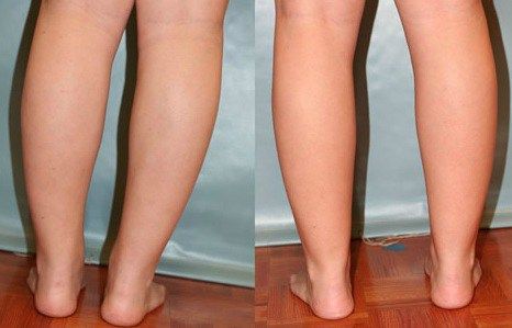 Large Calves and Ankles Ugly Legs, Fat Calves, Slim Calves, Thick Calves, Pretty Socks, Heavy Legs, Calf Leg, Big Calves, Free Powerpoint Templates