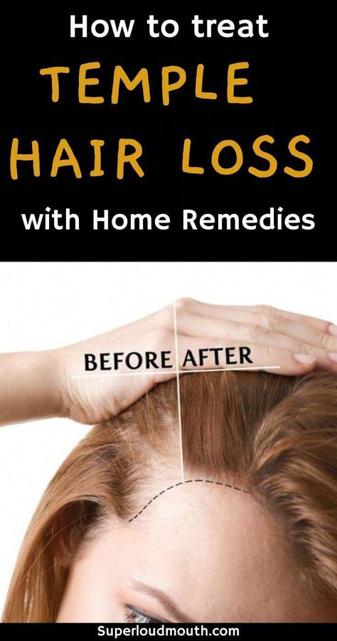 How to treat Hair Loss on Temples in 6 Simple ways Home Remedies For Hair, 4c Natural, Hair Remedies, Hair Regrowth, Hair Health, Grow Hair, Hair Cut, Home Remedies, New Hair