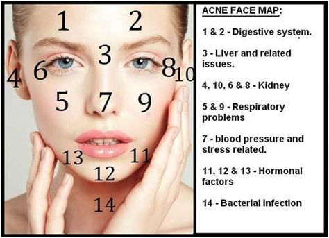 10 Causes And Simple Remedies For Pimples On Forehead Pimples On Face Meaning, Forehead Acne Cause, Doterra Acne, What Causes Pimples, Pimples On Forehead, Face Mapping Acne, Forehead Acne, Pimples Remedies, Pimples On Face