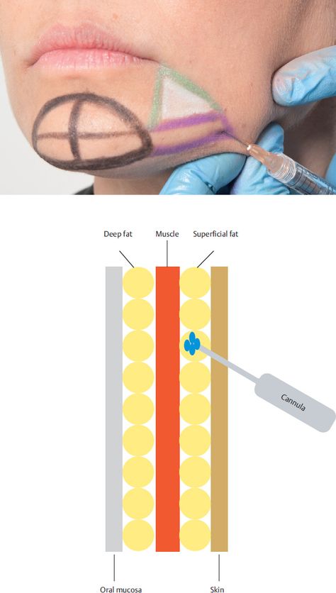 Chin Filler Injection, Face Injections, Botox Injection Sites, Dermal Fillers Lips, Facial Injections, Face Fillers, Aesthetic Dermatology, Facial Anatomy, Botox Face