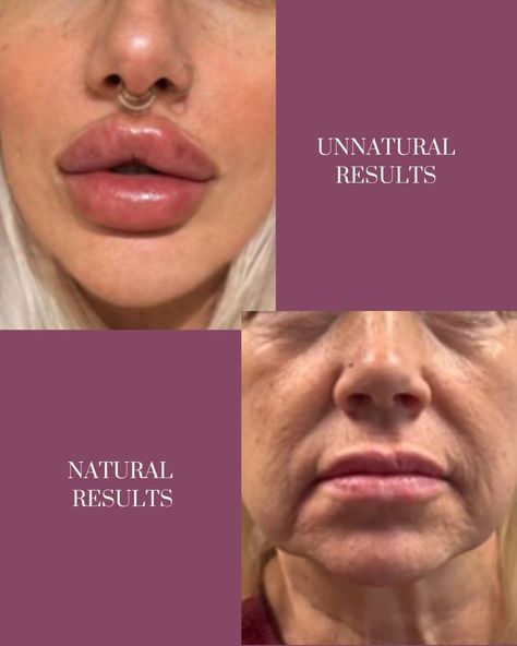 Fact vs. Fiction: Duck lips are just what happens with lip filler, right? Nope! Lip filler can add natural volume or create a fuller look based on your preference. If your lips are thinning with age, fillers can restore volume and smooth fine lines around the mouth. No duck lips—just gorgeous, natural results! 💋
#skincare #skincaretips #glowingskin #antiaging #milwaukee Natural Lip Fillers, Restylane Lips, Duck Lips, Restylane Lyft, Bridal Skin Care, Laser Skin Resurfacing, Fractional Laser, Lip Filler, Lip Beauty