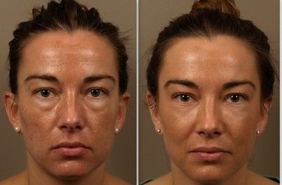 Get Rid of Eye Bags - Tear Trough Procedure Trough Filler Before After, Eye Trough Filler, Tear Trough Filler, Tear Trough, Reduce Dark Circles, Facial Plastic, Under Eye Bags, Dermal Fillers, Eye Bags