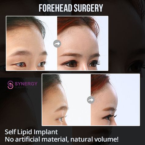 Forehead Filler, Forehead Surgery, Facial Aesthetic, Change Appearance, Plastic Surgery Korea, Massage Routine, Facial Massage Routine, Facial Aesthetics, Face Exercises