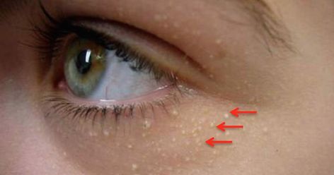 White Bump On Eyelid, White Pimples On Face, White Bumps On Face, Small Bumps On Face, Bumps Under Eyes, Moles On Face, Pimples Under The Skin, Pimples Remedies, Pimples On Face