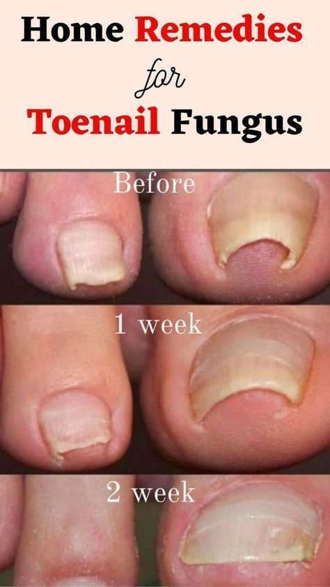 toe nail fungal infection treatment diy Toenail Fungal Infection, Toenail Health, Nail Remedies, Fingernail Fungus, Toenail Fungus Remedies, Nail Infection, Fungal Nail, Nails Today, Toenail Fungus