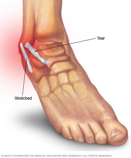 tears-tendonitis - Idaho Foot & Ankle Center Peroneal Tendon, High Ankle Sprain, Sprained Wrist, Twisted Ankle, Ankle Sprain, Smart Casual Work Outfit, Ankle Injury, Sprained Ankle, Body Confidence