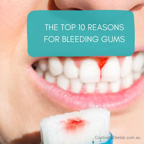 Bleeding gums are a common issue that can be caused by a variety of factors.  By understanding the top 10 reasons for bleeding gums, you can take steps to prevent and treat this uncomfortable and potentially harmful condition. 1. Gingivitis: The most common cause of bleeding gums is gingivitis, a mild form of gum disease caused by plaque buildup. Gingivitis can lead to more serious forms of gum disease if left untreated. Gum Diseases Chart, Healing Cavities, Gum Inflammation, Ways To Heal, Grills Teeth, Sesame Seed, Dental Humor, Before Going To Bed, Receding Gums