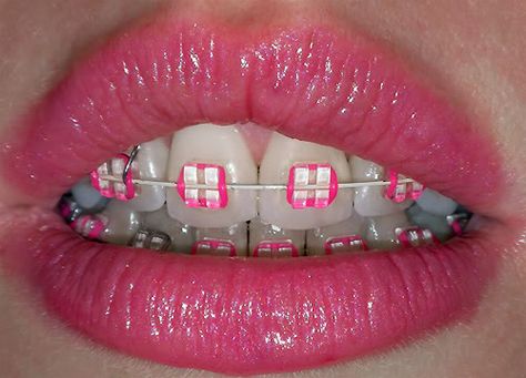 Think Pink! I took the plunge... At least choose a color you can love to make it go by even faster. Hot Pink Braces, Pink Braces, Braces Colors Combinations, Dental Braces Colors, Cute Braces Colors, Getting Braces, Diamond Teeth, Braces Tips, Braces Girls