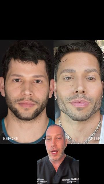 Jason Emer, MD on Instagram: "PICTURE PERFECT MALE FACIAL SCULPTING Our patient is a musical artist and wants to look his best while performing. He’s really craving a more chiseled jawline with pronounced cheeks. Using a combination of Bellafill and Radiesse filler, we’re going to enhance his already sculpted anatomy so that he looks contoured and natural. We are going to add structure to his jawline and give him a sharper, stronger look on his cheek bones. He got exactly what he was looking fo Chiseled Face Man, Mens Jawline Filler, Jawline Pictures, Chiseled Jawline Men, Hollow Cheeks Male, Cheek Bone Exercises, Male Jawline, Jawline Surgery, Men Jawline