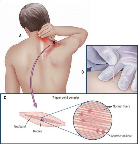 Dry Needling Trigger Points, Shoulder Trigger Points, Needling Therapy, Neck Muscle Pain, Dry Needling Therapy, Myofascial Pain Syndrome, Sports Physical Therapy, Muscle Knots, Dry Needling