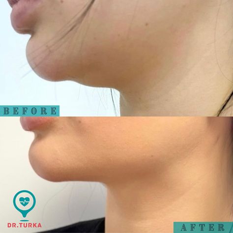 Double Chin Surgery, Chin Surgery, Double Chin Removal, Chin Augmentation, Double Chin, 2024 Vision, Surgery, Vision Board, France